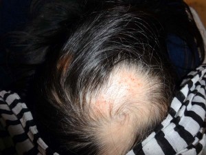 alopecia case study crown of head shot 1