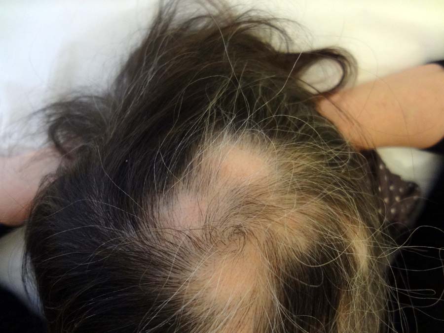 alopecia case study crown of head shot 2 weeks later | Zoe Mountstephen